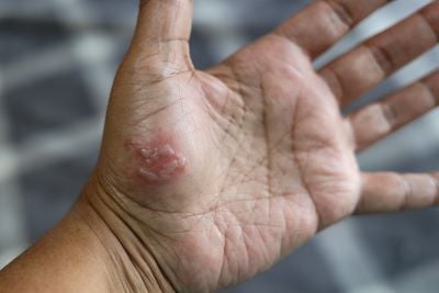 Image of a second-degree burn on the palm of the hand